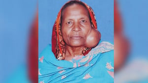 টিউমারের যন্ত্রণায় কাতরাচ্ছেন নিঃস্ব অমিছা বেওয়া