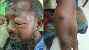 সুন্দরগঞ্জে ১১ জনের শরীরে অ্যানথ্রাক্সের উপসর্গ, ৫ জন হাসপাতালে ভর্তি