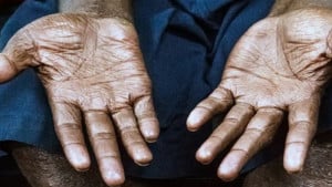 তিন হাজারের বেশি কুষ্ঠ রোগী শনাক্ত হচ্ছে বছরে