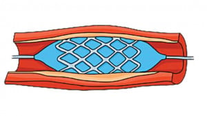 হার্টের অবৈধ রিং ব্যবসা, জড়িত চিকিৎসক-নার্স