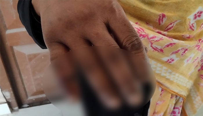 দেড় মাসে অ্যানথ্রাক্সে আক্রান্ত ৪৫০ জন